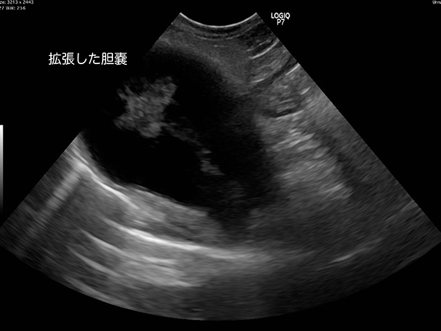 卵巣嚢腫が破裂するとどのような症状が現れますか?