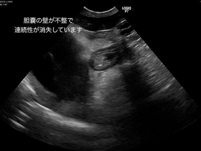 胆嚢粘液嚢腫・胆嚢破裂