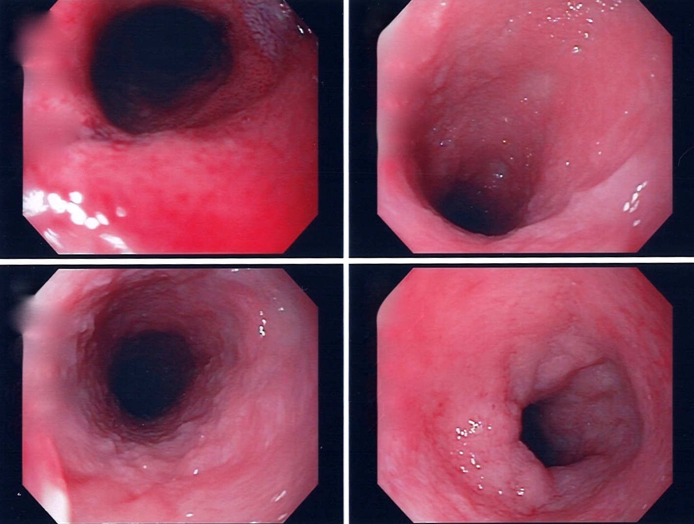 炎症性腸疾患（IBD）