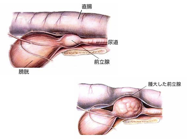 前立腺疾患