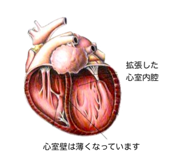 拡張型心筋症