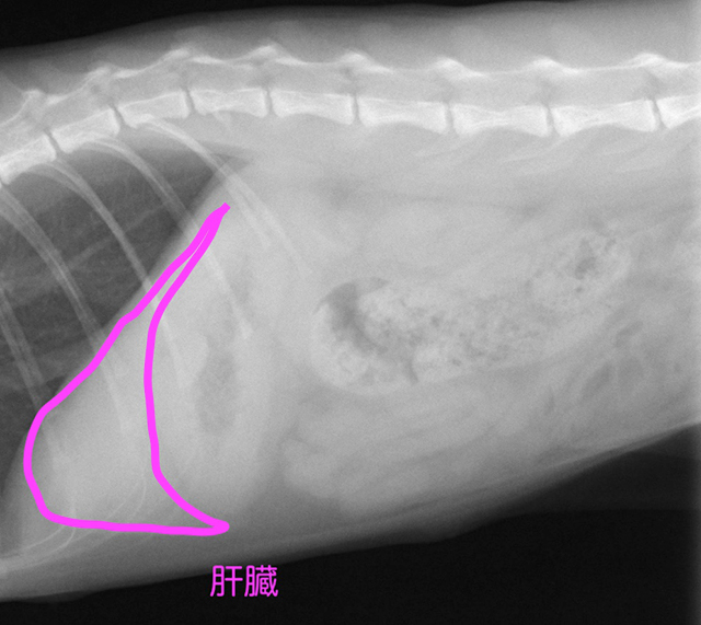 門脈体循環シャント