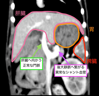 門脈体循環シャント