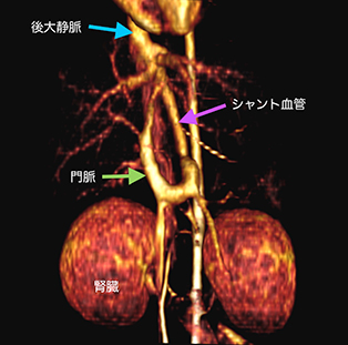 門脈体循環シャント