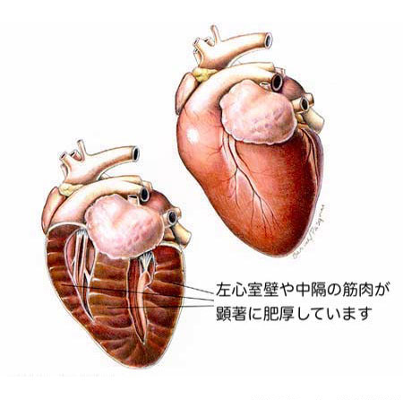 肥大型心筋症