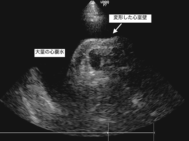 心タンポナーデ