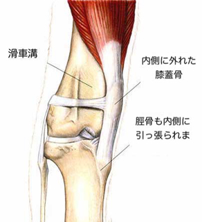 膝蓋骨脱臼